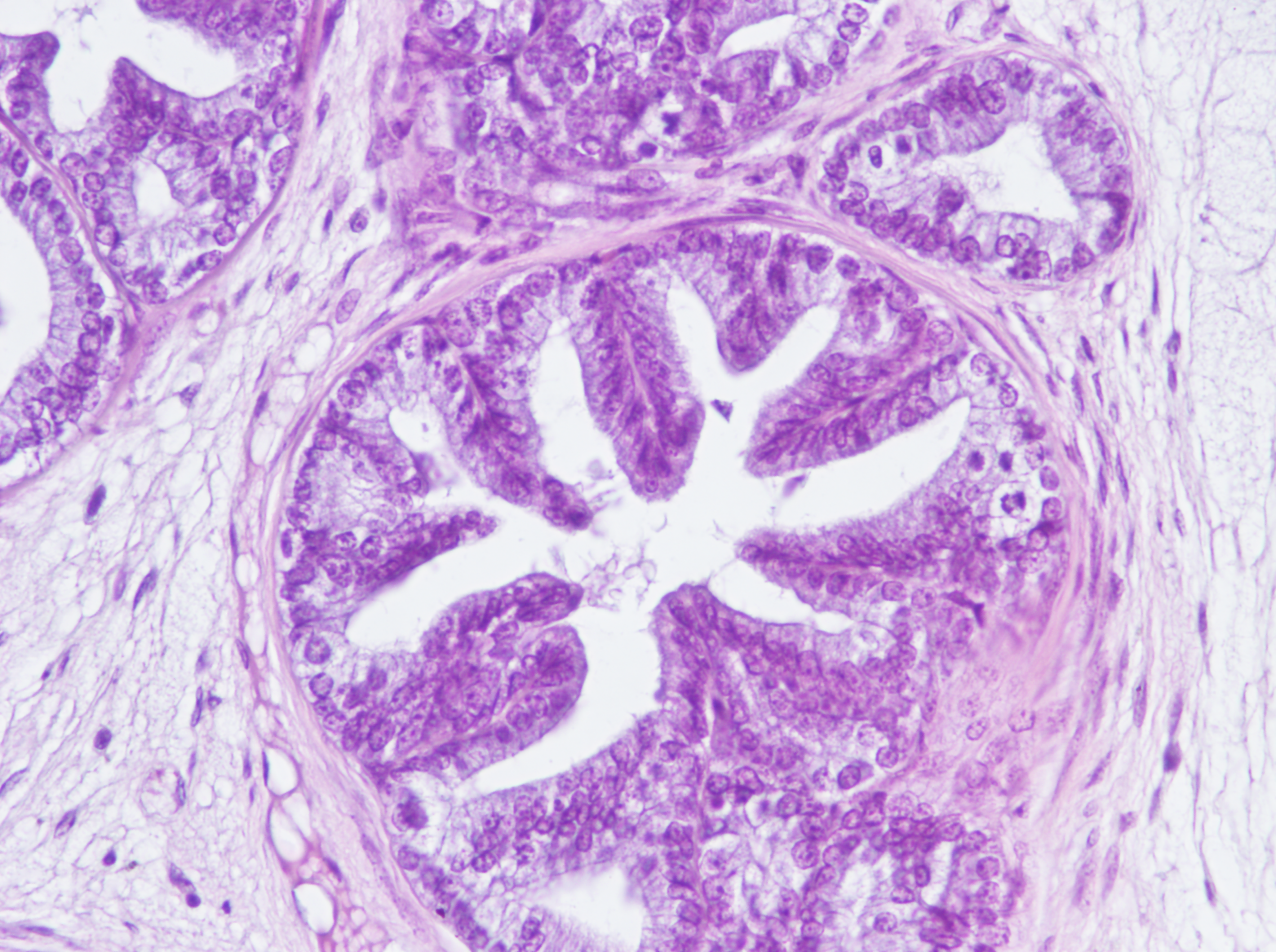 Fotomicrografia da próstata de camundongos TRAMP (20 semanas de idade): Neoplasia intraepitelial prostática (NIP) de alto grau e adenocarcinoma bem diferenciado. (Hematoxilina-Eosina, 400x)